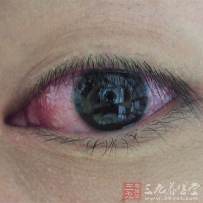 眼睛痒是怎么回事 应该如何有效治疗(3)