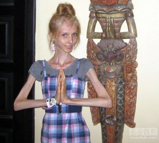 世界上最瘦的人 俄罗斯美女只有20公斤