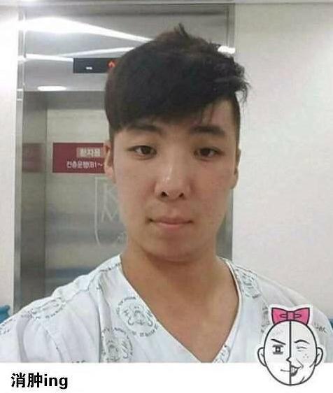 男子染头发后头肿脸涨 自拍记录全过程(3)