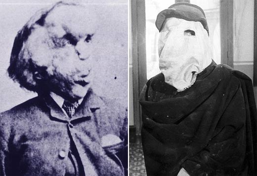 19世纪大象人畸形秘闻 _西窗史语