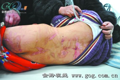 触目惊心!恶母火钳烙烫12岁女儿 致<em>溃烂</em>处现骨