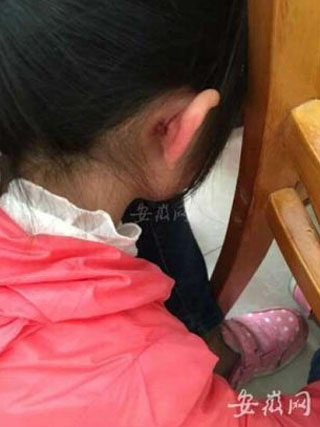 安徽小学女生做题出错被体罚 脸有掌痕耳根撕