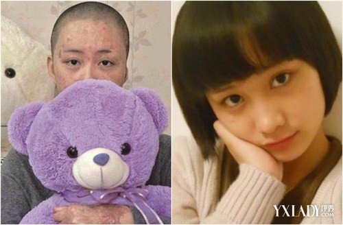 合肥<em>毁容少女</em>不满172万赔偿上诉(1)_法治频