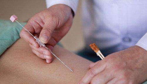 Traditional Chinese medicine acupuncture attracts fans abroad